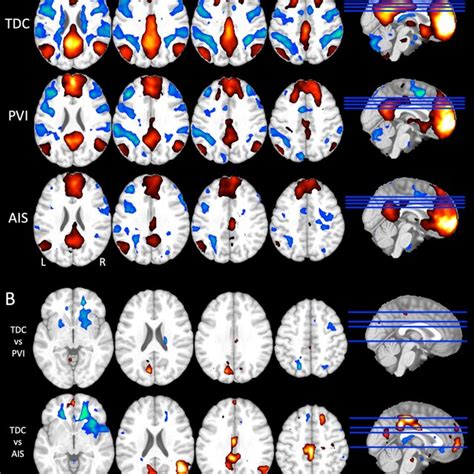 Seed To Voxel Analyses Using The Medial Prefrontal Cortex Mpfc From Download Scientific