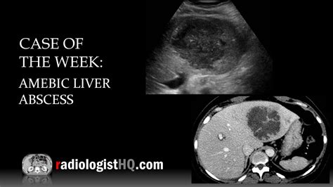 Case Of The Week Amebic Liver Abscess Ultrasound And Ct Youtube