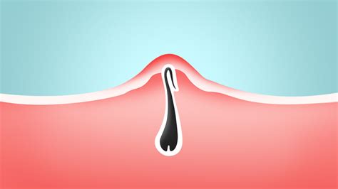 How To Treat Ingrown Hairs What Causes Ingrown Hair What Is An