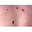 Spreading Melanoma Skin Cancer  Stock Image C009/6840 Science