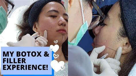 RASANYA DI BOTOX FILLER DI DERMASTER HARGANYA YouTube