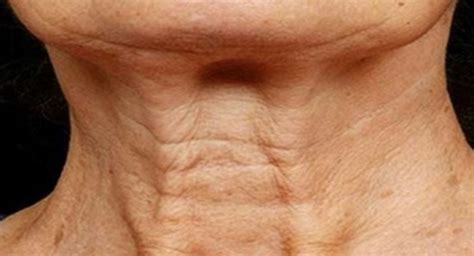 Sagging Extra Loose Skin On Neck Causes And Cures Skincarederm