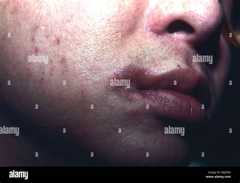 Contact Dermatitis Jewelry Hi Res Stock Photography And Images Alamy