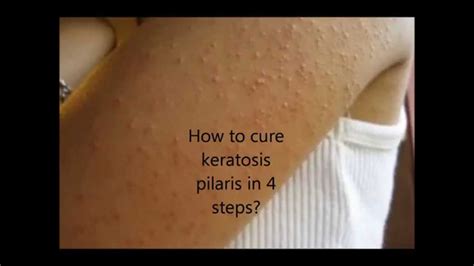 How To Cure Keratosis Pilaris In 4 Easy Steps Youtube