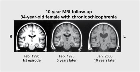 Understanding Structural Brain Changes In Schizophrenia Abstract