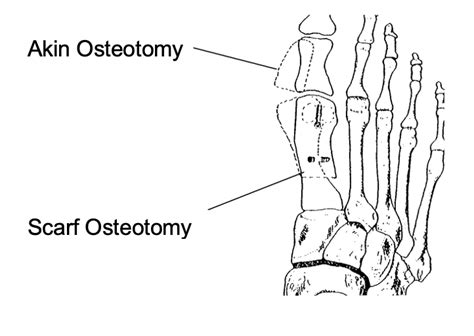 Bunion Surgery The Sajid Shariff Clinic