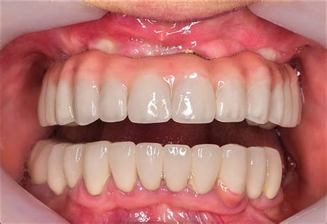 Fixed Implant Denture - Athens, GA | Watkinsville, GA — Hall Dental