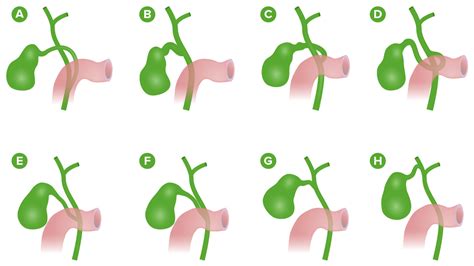 Gallbladder Cystic Duct Anatomy