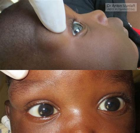 Dermoid Cyst Tropical Ophthalmology