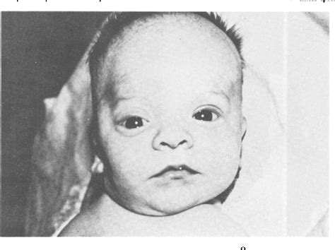 Figure 1 From Noonan Syndrome Fig 4 An Adolescent With Noonan Syndrome Semantic Scholar