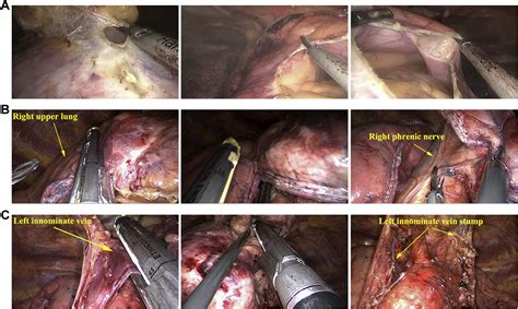 Modified Subxiphoid Thoracoscopic Thymectomy For Locally Invasive