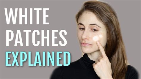 White Patches On The Face Explained Pityriasis Alba Dr Dray White The