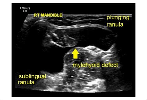 Transverse Sonogram Of The Sublingual And Plunging Ranula Through A