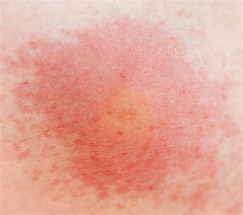 These Pictures Will Help You Id The Most Common Bug Bites This Summer