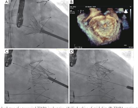 Figure 3 From Early Experience Of Tiara Transcatheter Mitral Valve