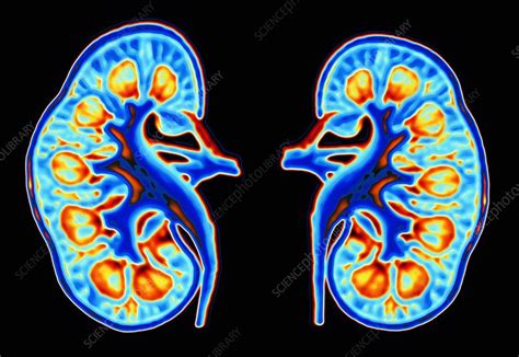 Human Kidneys Stock Image P5500142 Science Photo Library