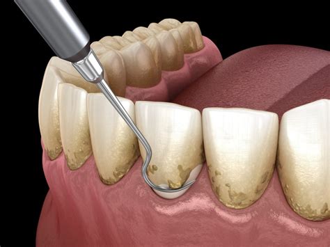 Gum Disease Periodontal Disease Treatment Capital Dental