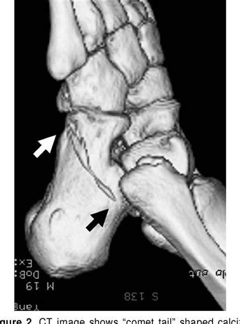 Figure From Calcific Tendinitis Of The Peroneus Longus Case Report Hot Sex Picture