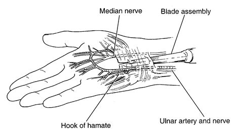 Carpal Tunnel Syndrome Handout Dr Thomas Trumble Md