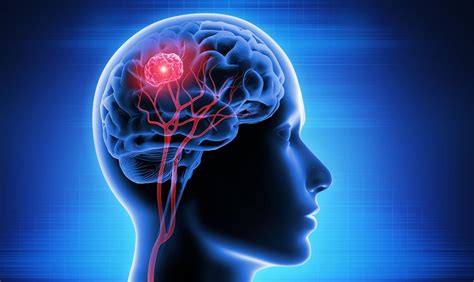 Understanding Brain Tumour Cancer Symptoms A Comprehensive Guide By