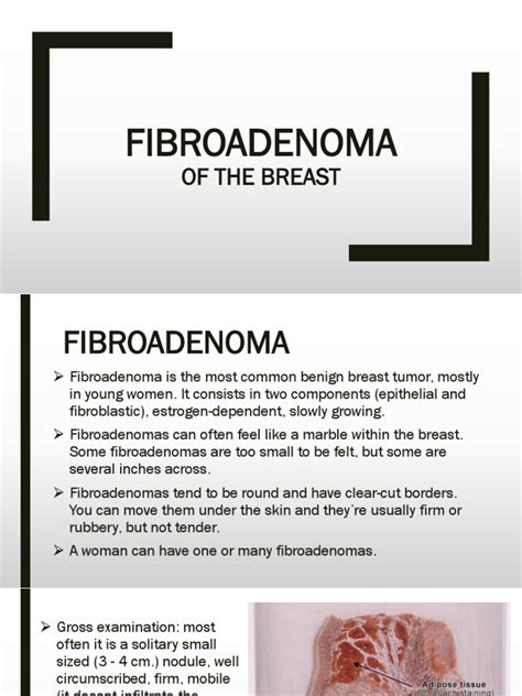 Fibroadenoma Of The Breast Clinical Medicine Diseases And Disorders