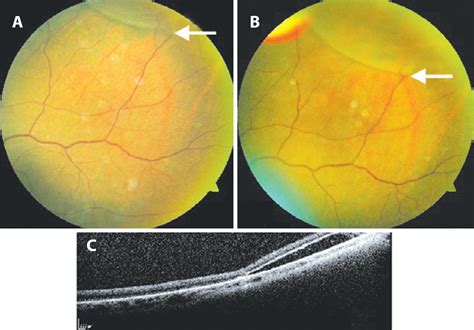 Scielo Brasil Case Report Pneumatic Retinopexy For The Treatment