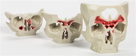 Rhinology And Skull Base Surgery Department Of Otorhinolaryngology Mayo Clinic Research