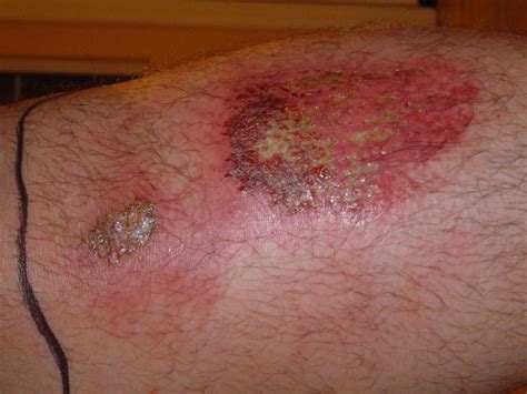 What Does Infected Road Rash Look Like Sanycrm