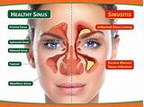 Ethmoid Sinusitis Treatment