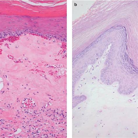 Classical Cases Of Lichen Sclerosus A Typical Example Of Lichen