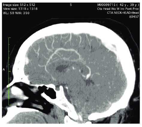 Sagittal View Of A Ct Angiogram Of The Head At The Level Of Lateral