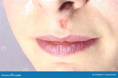 Herpes Stock Photo Image Of Skin Mouth Women Health 27504576