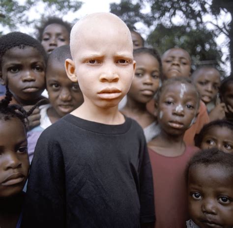 African Albino Boy Albinoism Is Often Demonized In Africa With Many
