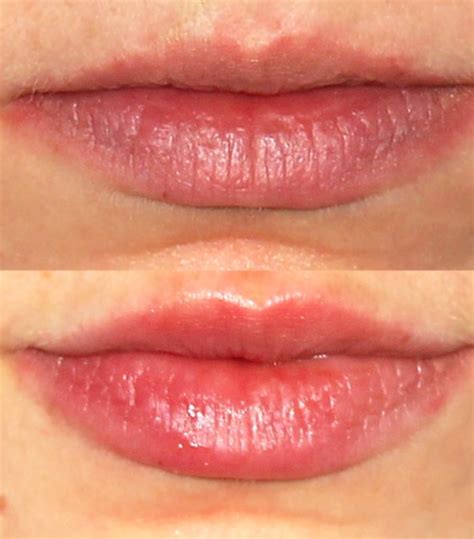 I Tried Lip Filler—heres What To Expect Before And After