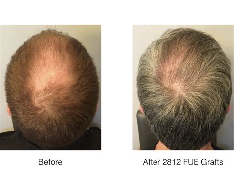 Fue Hair Transplant In Norwood 6 Patient Marc Dauer Md Hair