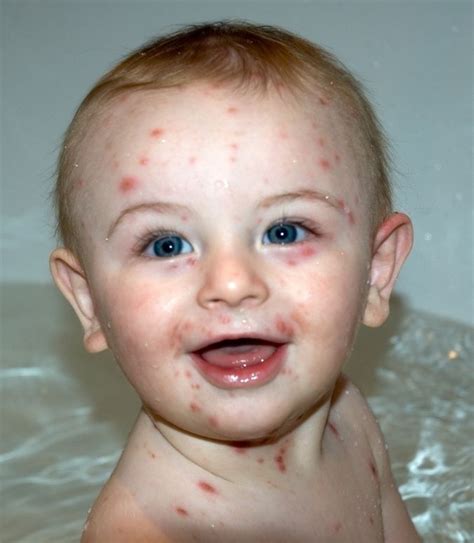 50 Best Ideas For Coloring Child Face Rash