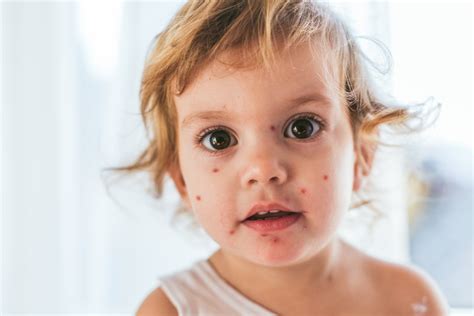 23 Malattie Dei Bambini Che I Genitori Dovrebbero Conoscere