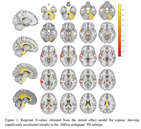 Accelerated Longitudinal Brain Atrophy In The ‘diffuse Malignant