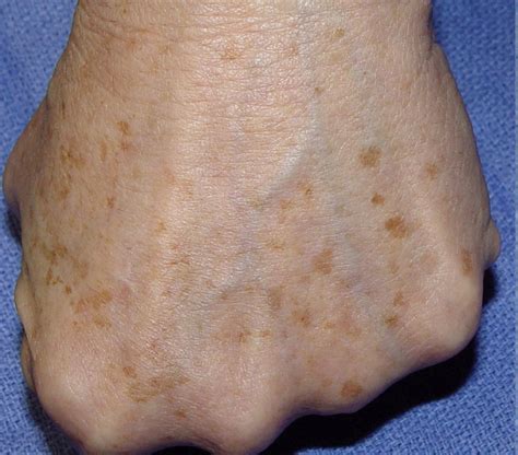 Age Spots On Hands And What Causes Them Natural Skin Care Remedies