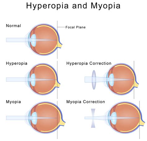 Myopia Nearsightedness Eye Health Central