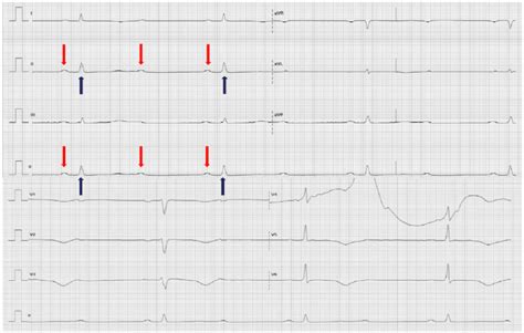 Electrocardiograma Que Demuestra Bloqueo Auriculo Ventricular De Tercer