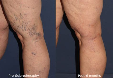 Sclerotherapy San Diego Ca Cosmetic Laser Dermatology