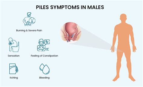 Best Way To Cure Piles In 3 Days Symptoms Causes And Treatments Habilite Clinics Blog