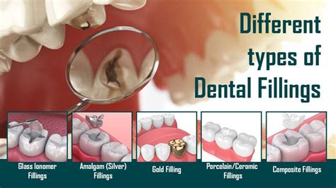 What Are The Different Types Of Dental Fillings My Gentle Dentist