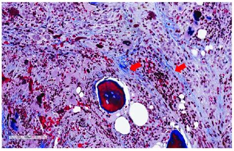 Bone Marrow Fibrosis In Myelofibrosis Pathogenesis Prognosis And