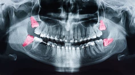 Growing Wisdom Teeth Pain On X Ray Stock Photo Image Of Head