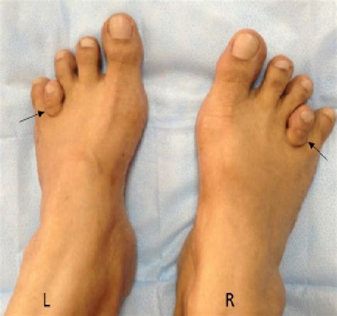 Clinical Photograph Of Bilateral Short Fourth Metatarsals L Left R