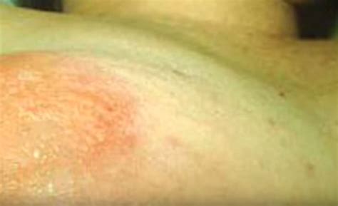 There S A Rare Form Of Breast Cancer That Looks Like A Sunburn Rash