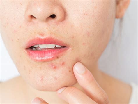 How To Care For Dry Acne Prone Skin Okka Beauty