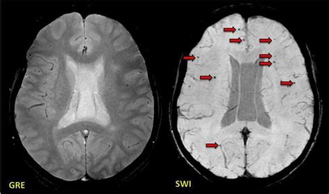 Post Traumatic Brain Injury Showing Many More Axonal MEDizzy